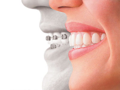 The image features a split-screen comparison of a person s natural smile with their teeth aligned by an orthodontic appliance, highlighting the transformation achieved through dental braces.