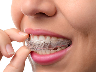 An adult female hand holding a transparent dental aligner with a slight smile.