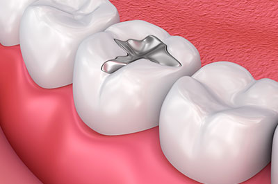 The image shows a close-up view of a dental implant integrated into a tooth with surrounding teeth and gums, set against a pink background that resembles a mouth.