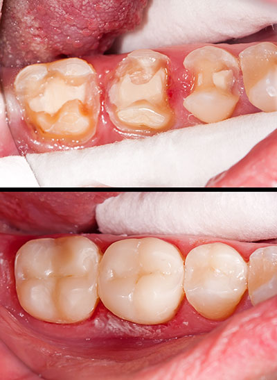 The image shows a close-up view of a person s teeth with severe tooth decay and damage, emphasizing oral health issues.