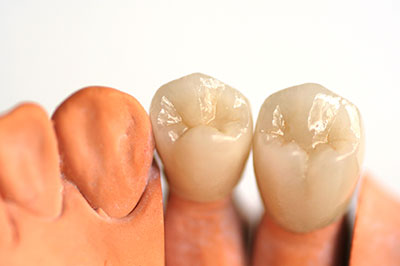 This image shows a set of artificial teeth with visible tooth enamel, presented against a white background.