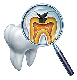 The image shows a magnified view of a human tooth with an X-ray overlay, revealing its internal structure and the presence of a cavity, viewed through a magnifying glass.