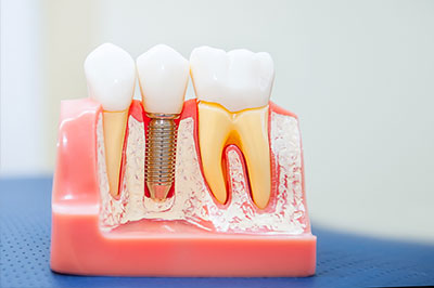 The image features a model of a human mouth with teeth and gums, showcasing dental implant technology with visible screws and support structures.