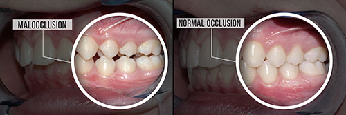 The image shows a before-and-after view of a dental implant procedure with a focus on a patient s teeth and gums, highlighting the transformation from missing teeth to a completed restoration.