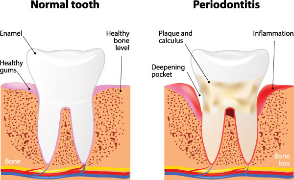 The image presents a detailed illustration of a tooth s structure and its transformation into a periodontitis-affected state, highlighting the normal tooth, healthy gum, bone loss, and inflammation in the affected area.