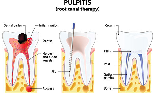 The image shows a diagrammatic illustration of a tooth with pulpitis, labeled with annotations indicating various parts of the tooth s structure and the process of pulpitis.