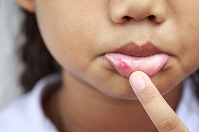 The image shows a close-up of a person s face with an exaggeratedly large finger pointing at a small, red bump on their skin.