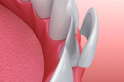 The image depicts a close-up view of a dental implant fixture with a pink gum background.