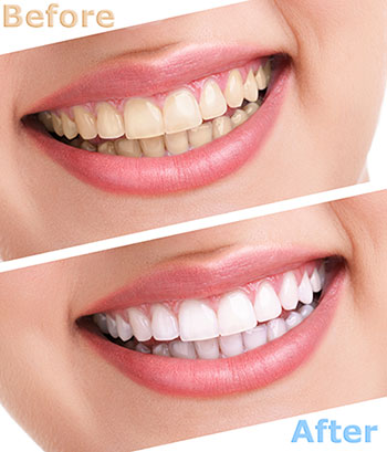 The image shows a side-by-side comparison of a person s teeth before and after dental treatment, highlighting the transformation achieved through cosmetic dentistry.